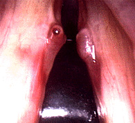 Dark image of vocal cyst