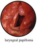 Close up of a laryngeal papilloma