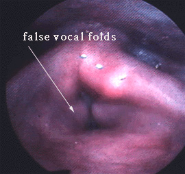 Close up of MTD in woman's vocal cords