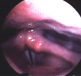 Close up of MTD in woman's vocal cords while being coached