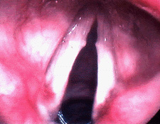 Close up of vocal fold nodule