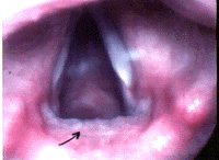A close up of effect of acid reflux on the vocal folds
