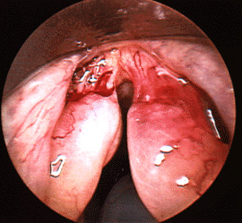 Close up of vocal folds with Reindes edema