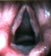 Close up of vocal folds Reinkes edema procedure later post-op